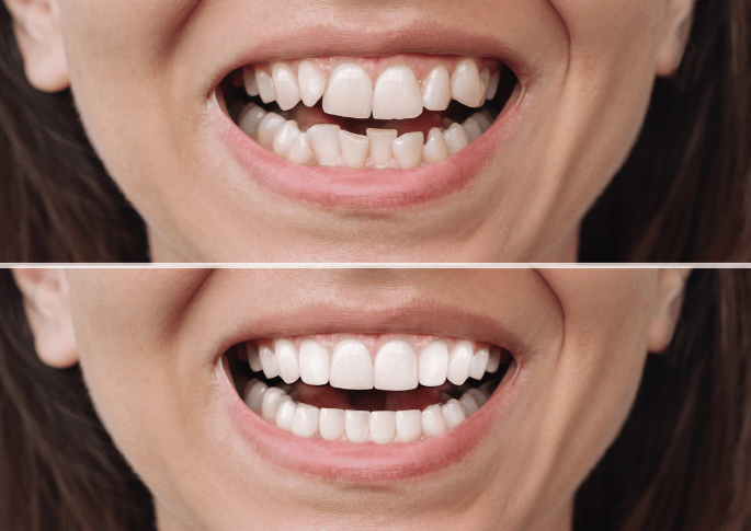 invisalign for misaligned teeth